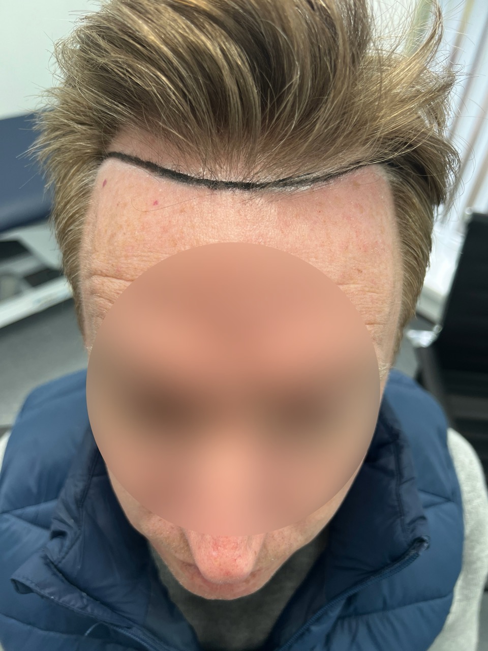 Pre-Op: Frontal hairline & temples