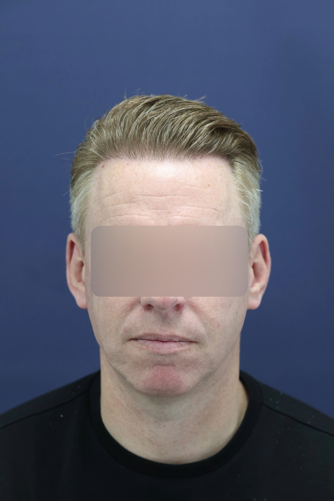 Post-Op: Frontal hairline & temples