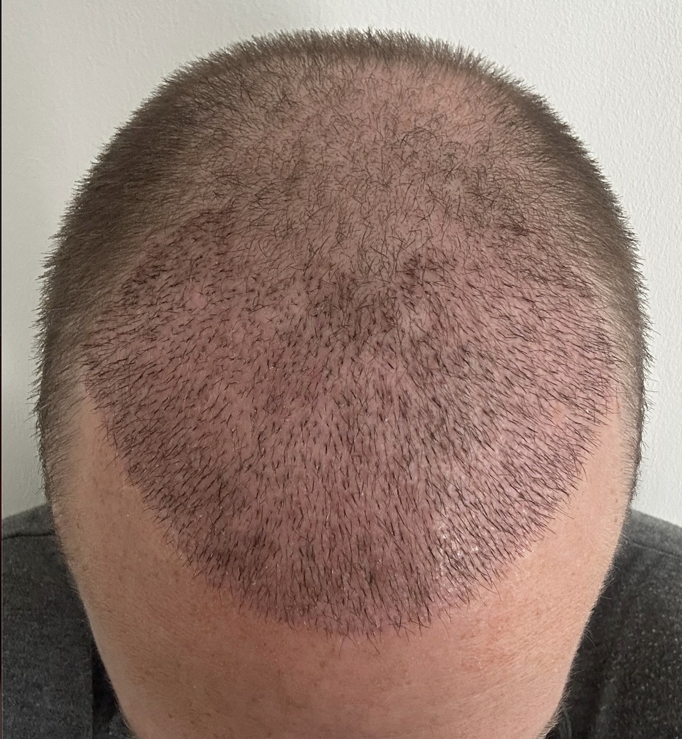 3 Weeks: Crown restoration — 12-month progression