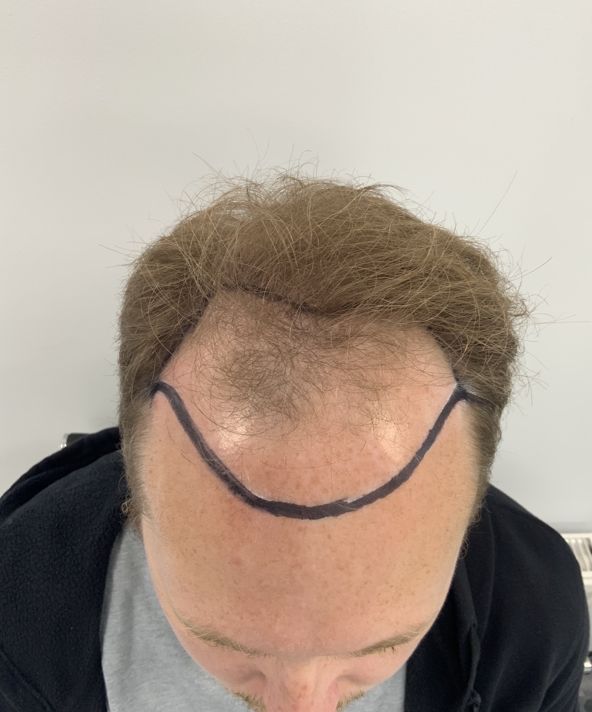 Pre-Op: Crown restoration — 12-month progression