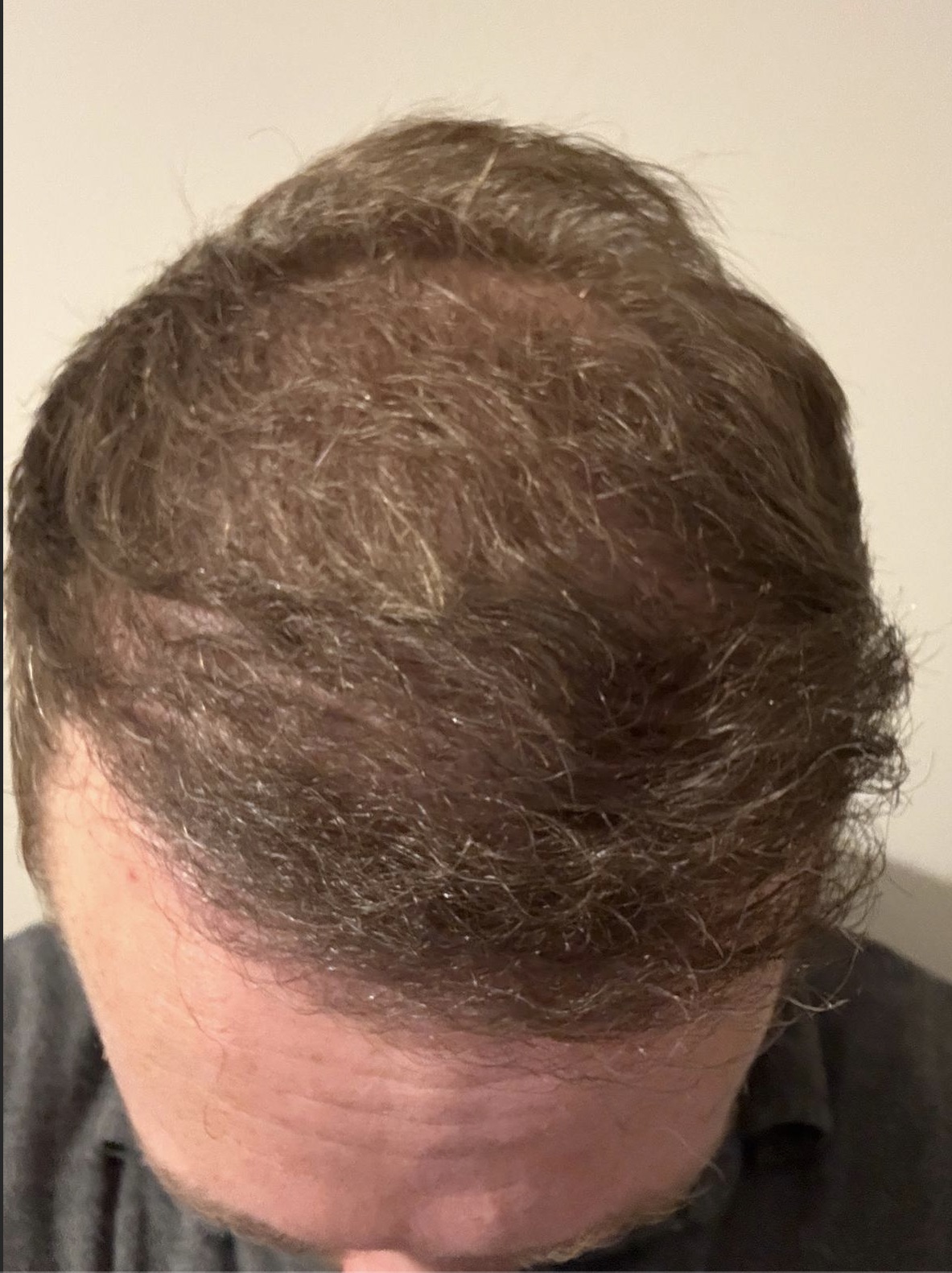 10 Months: Crown restoration — 12-month progression