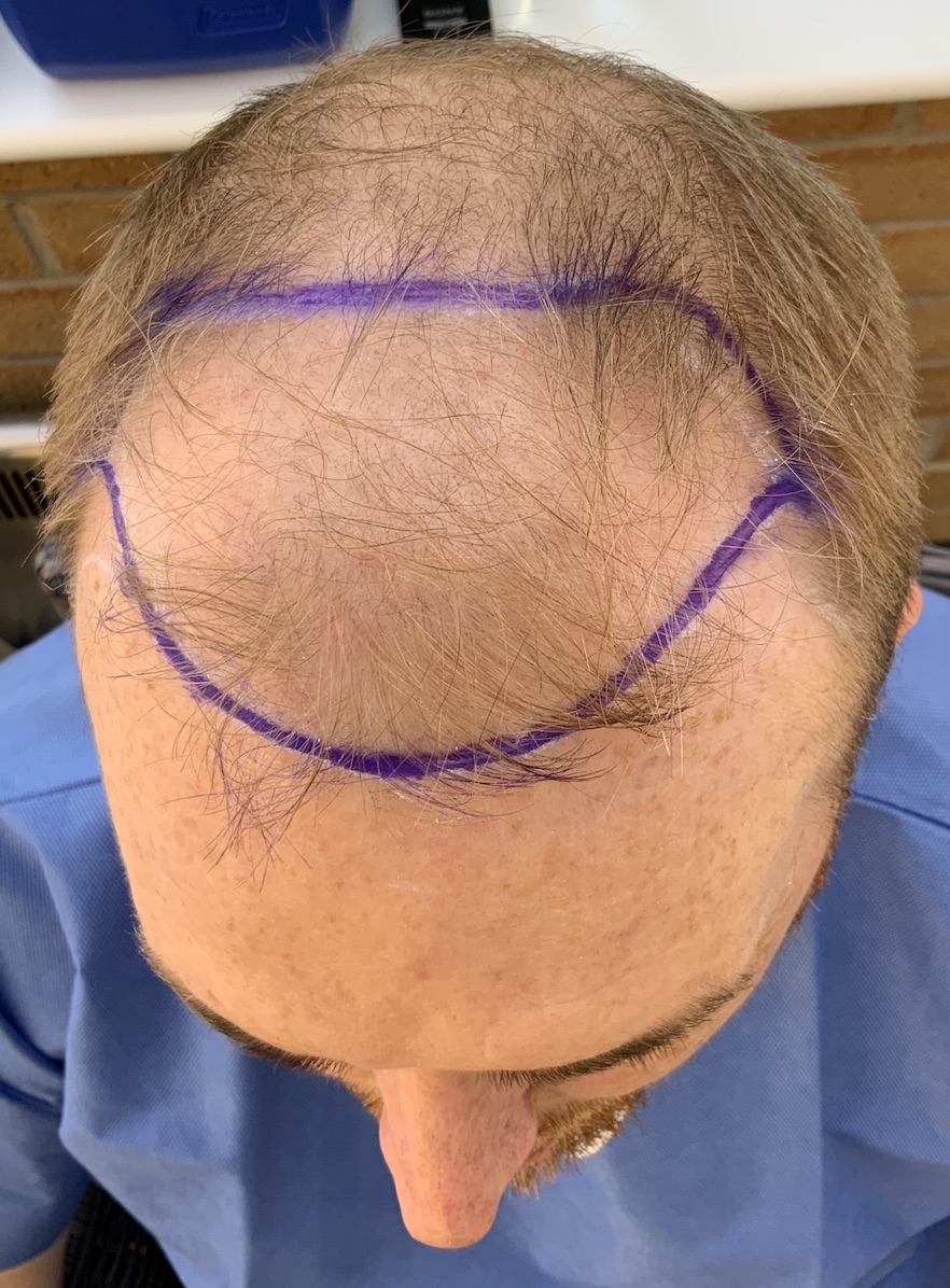 Pre-Op: Receding hairline restoration
