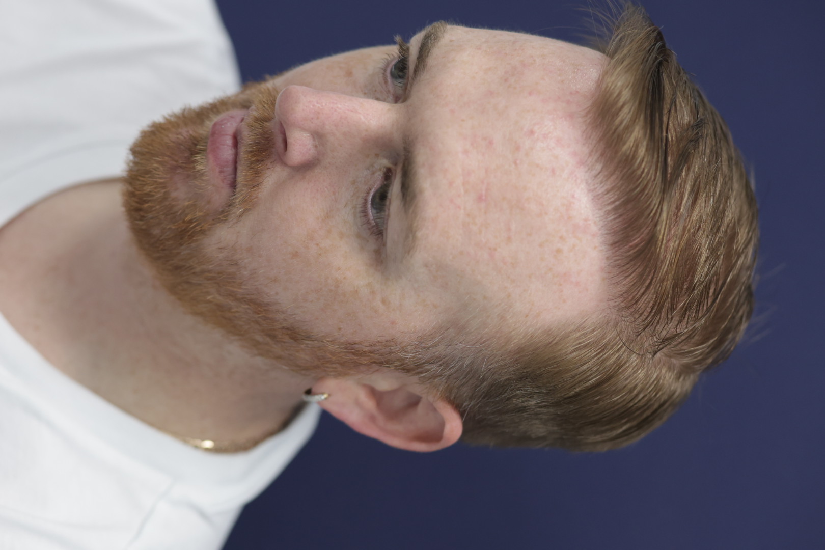 Post-Op: Receding hairline restoration
